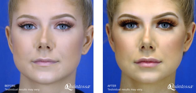 JUVEDERM LIPS FILLER BEFORE AFTER